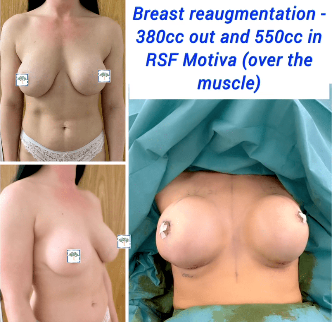 Breast re-augmentation 380cc out and 550cc in
