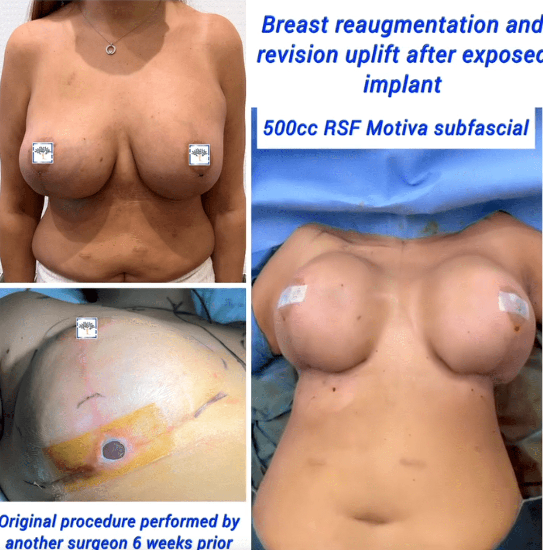 Breast re-augmentation and uplift after exposed implant - the Harley Clinic