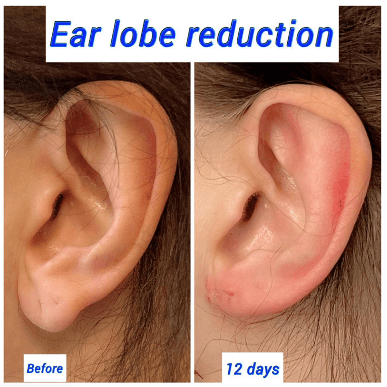 before and after earlobe reduction surgery, the Harley Clinic London
