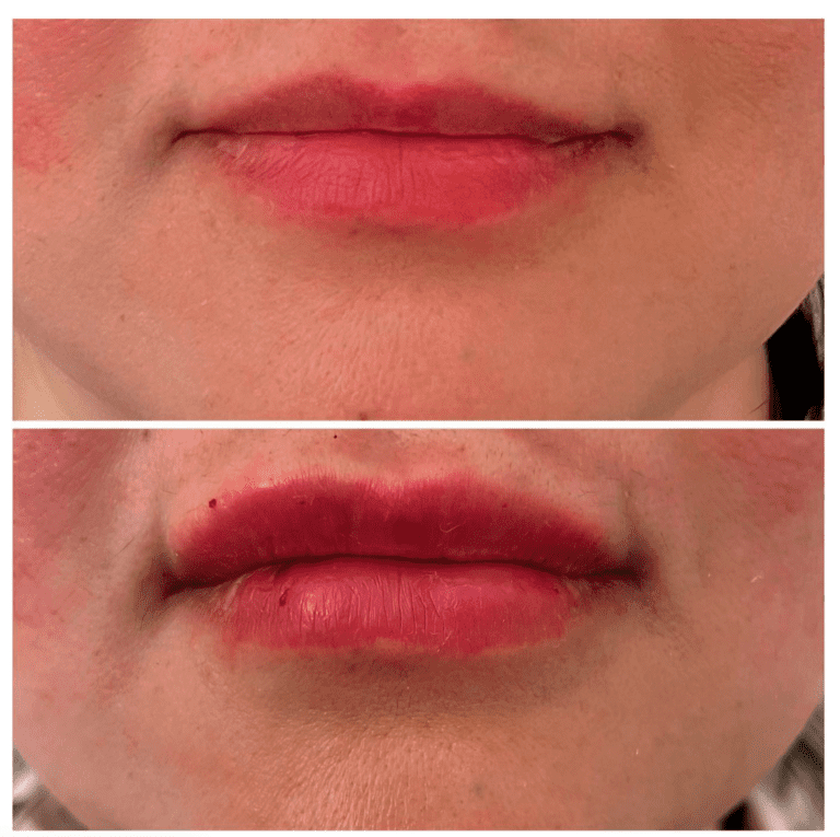 Before and after lip filler at the Harley Clinic