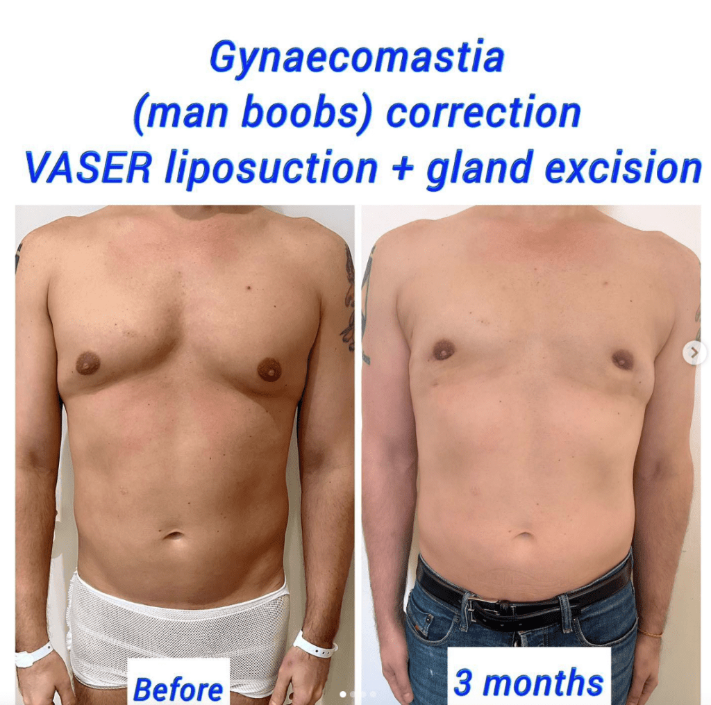 Gynaecomastia (man boobs) and Vaser liposuction - before and after