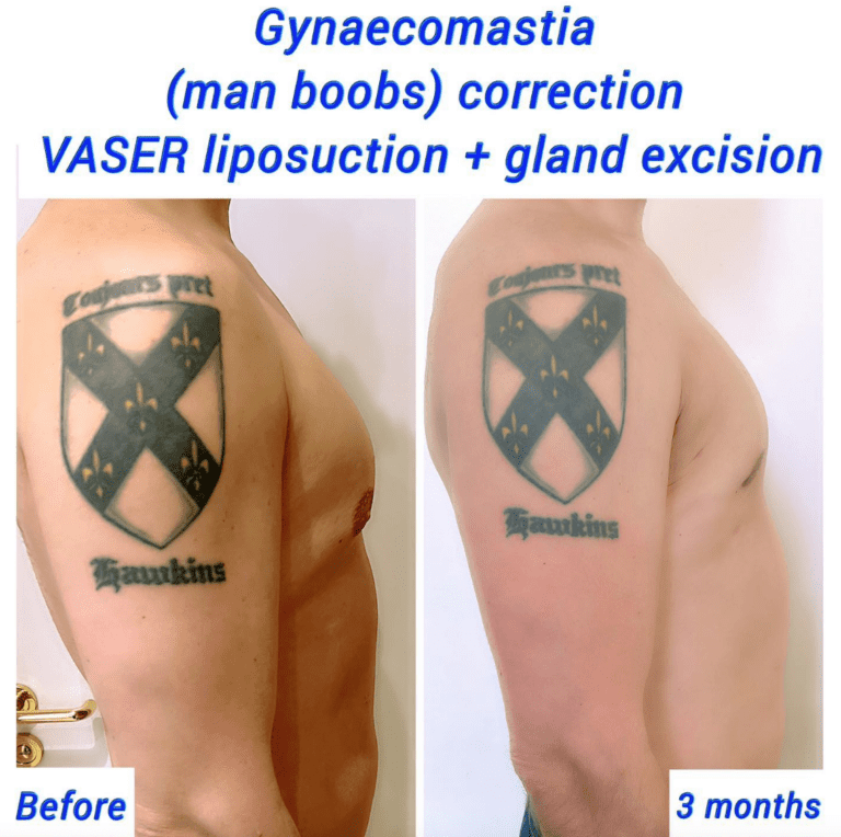 Gynaecomastia and Vaser liposuction - before and after