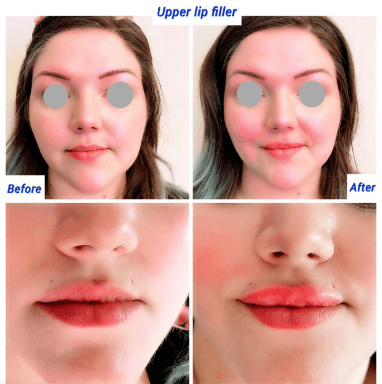 Before and after upper lip filler at the Harley Clinic