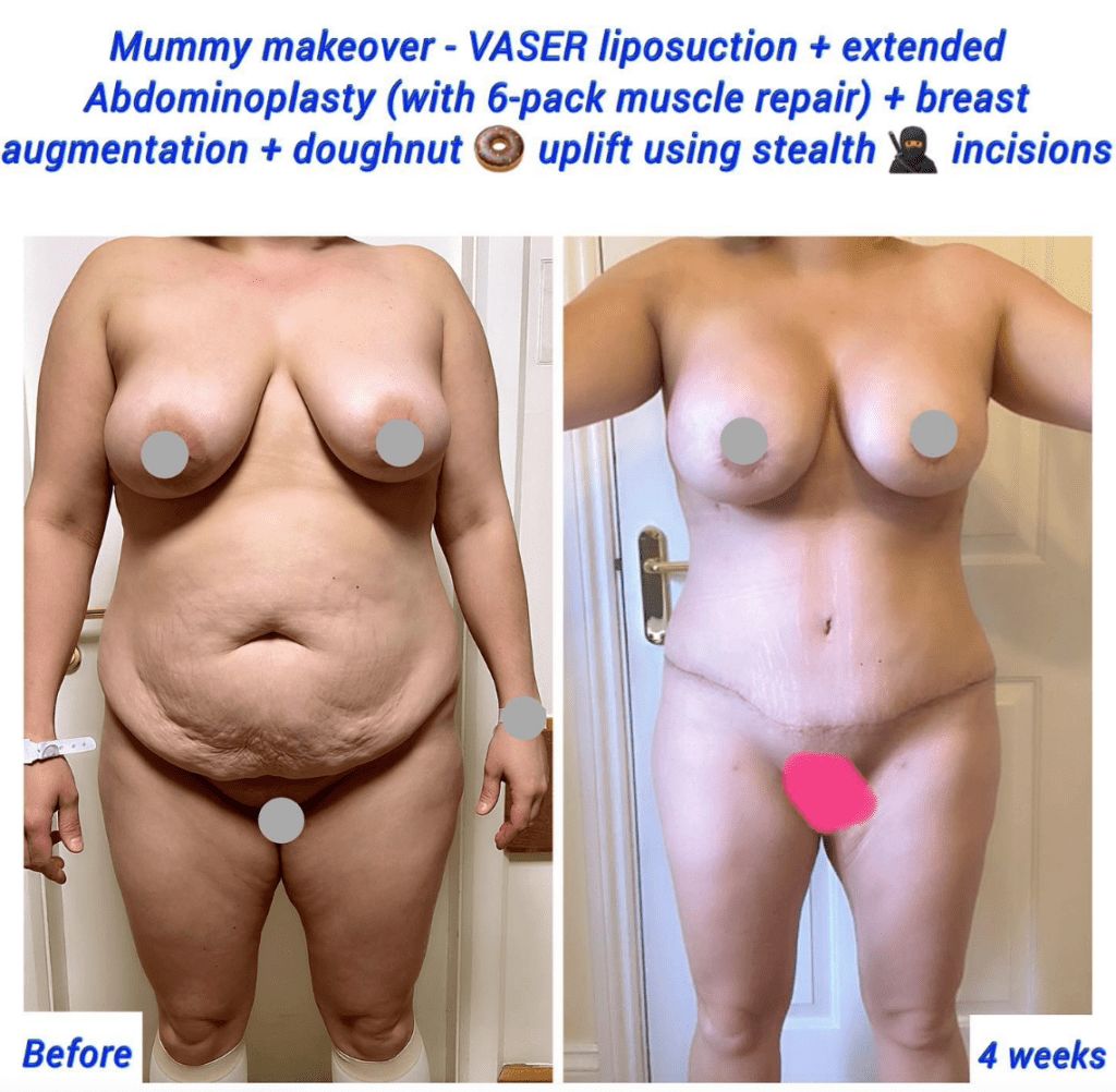 Mummy makeover at the Harley Clinic (VASER lipo, tummy tuck, breast augmentation, breast uplift)