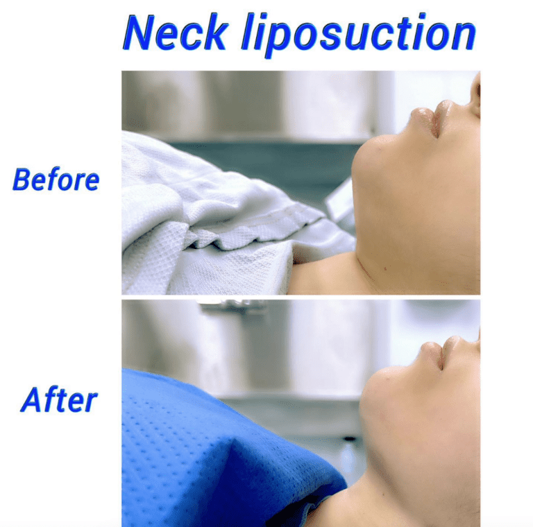 Before and after neck liposuction