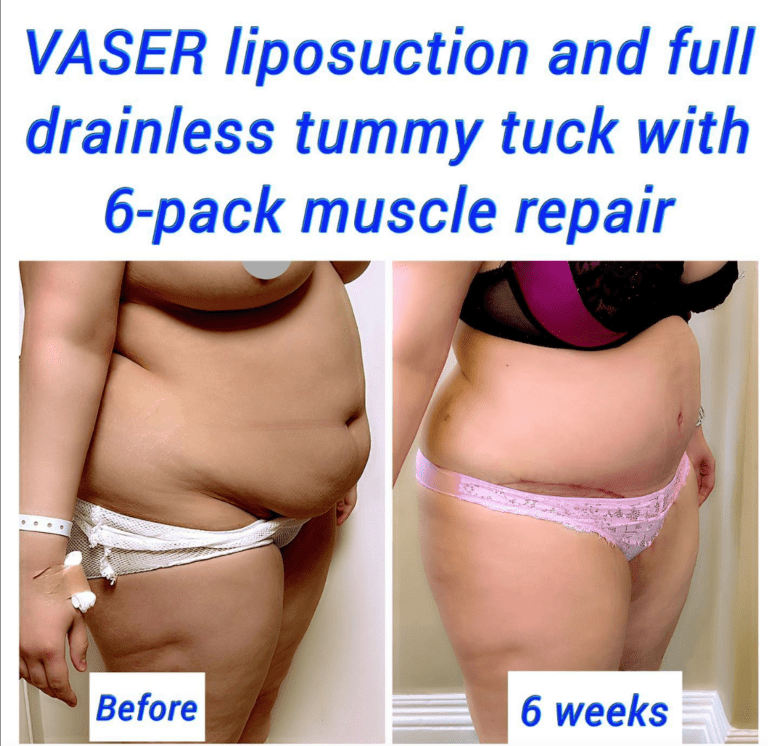 vaser liposuction and full drainless tummy tuck with 6-pack muscle repair