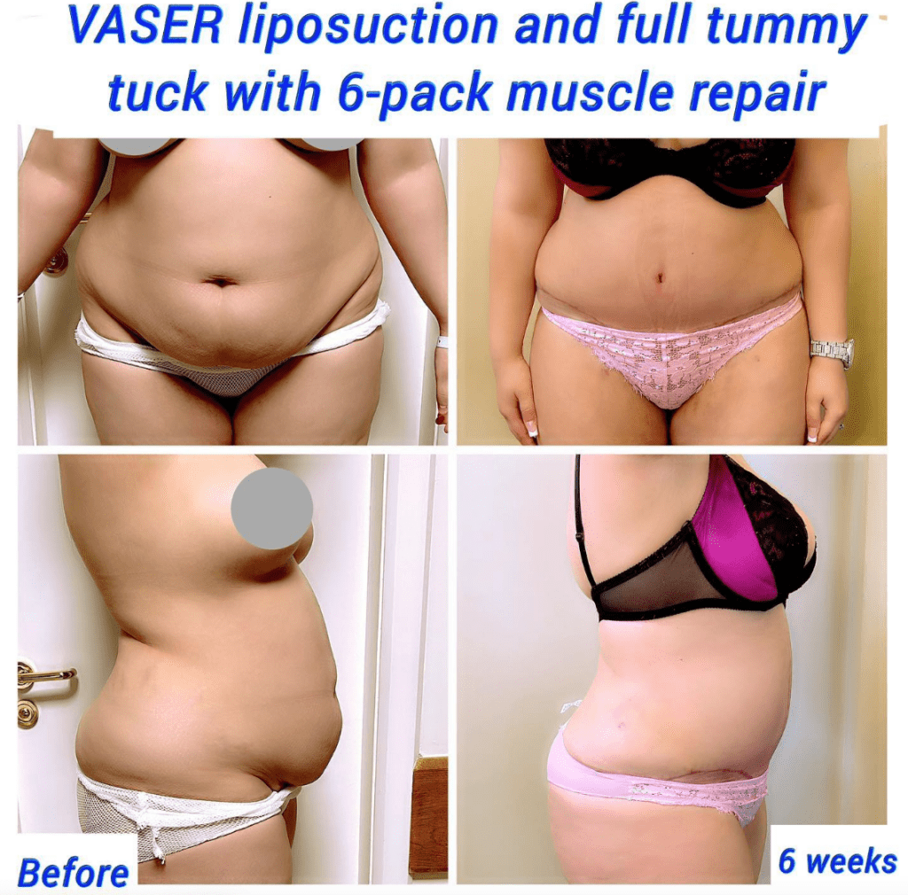 liposucción vaser y abdominoplastia completa sin drenaje con reparación muscular en pack de 6