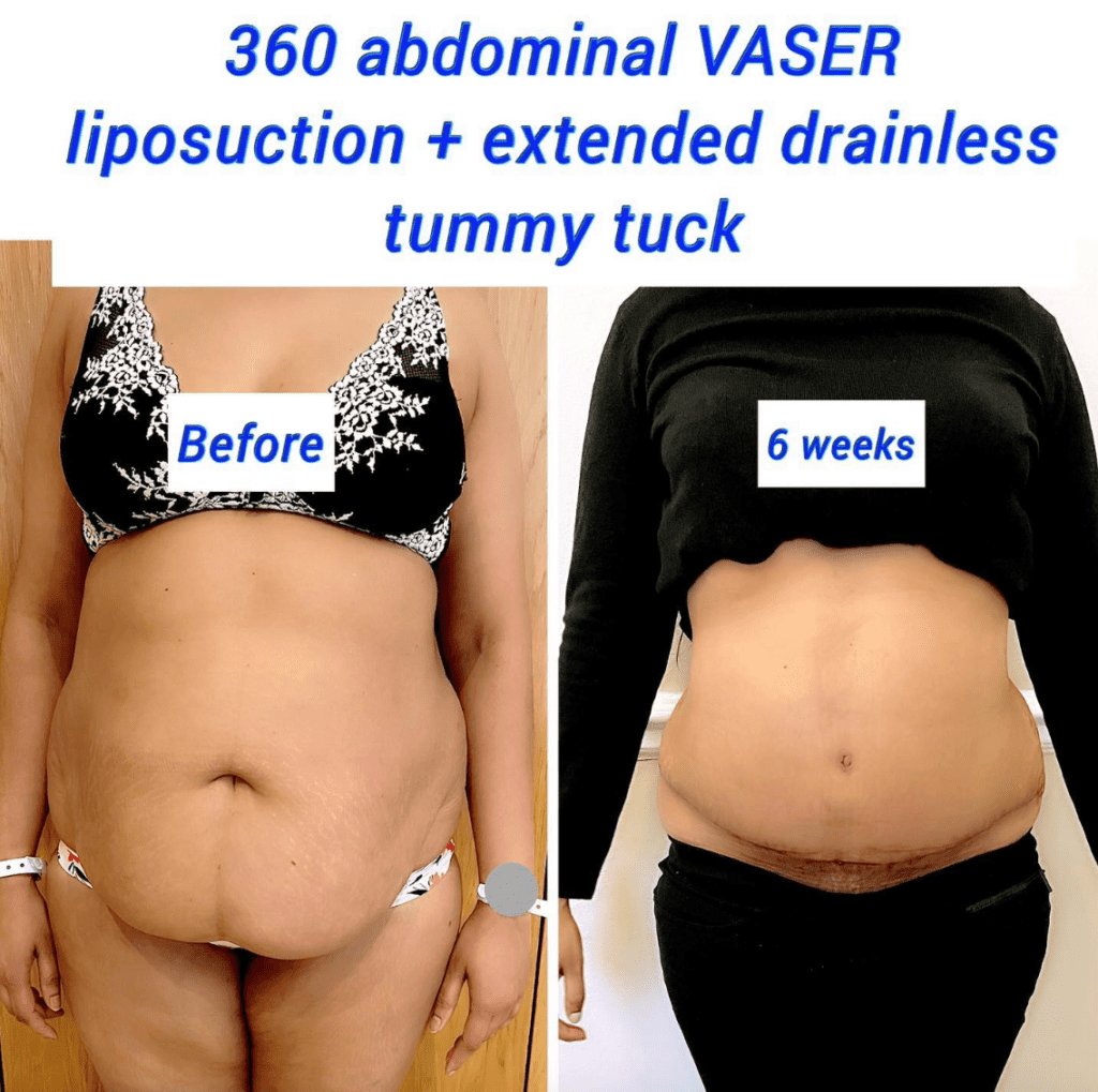 Liposucción Vaser abdominal 360° y abdominoplastia sin drenaje