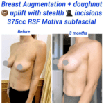 Before and after breast augmentation 375cc RSF Motiva + doughnut breast lift