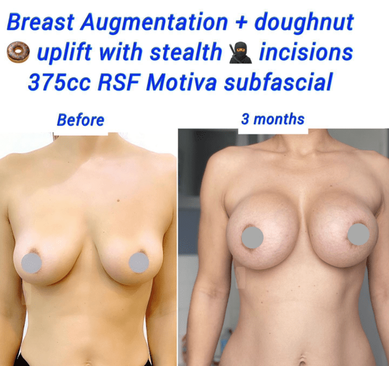 Before and after breast augmentation 375cc RSF Motiva + doughnut breast lift