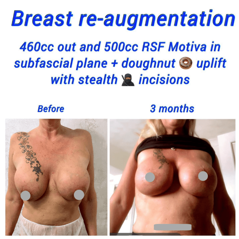 Before and after breast and re-augmentation - 46-cc out and 50cc RSF Motiva in subfasical plane and doughnut uplift