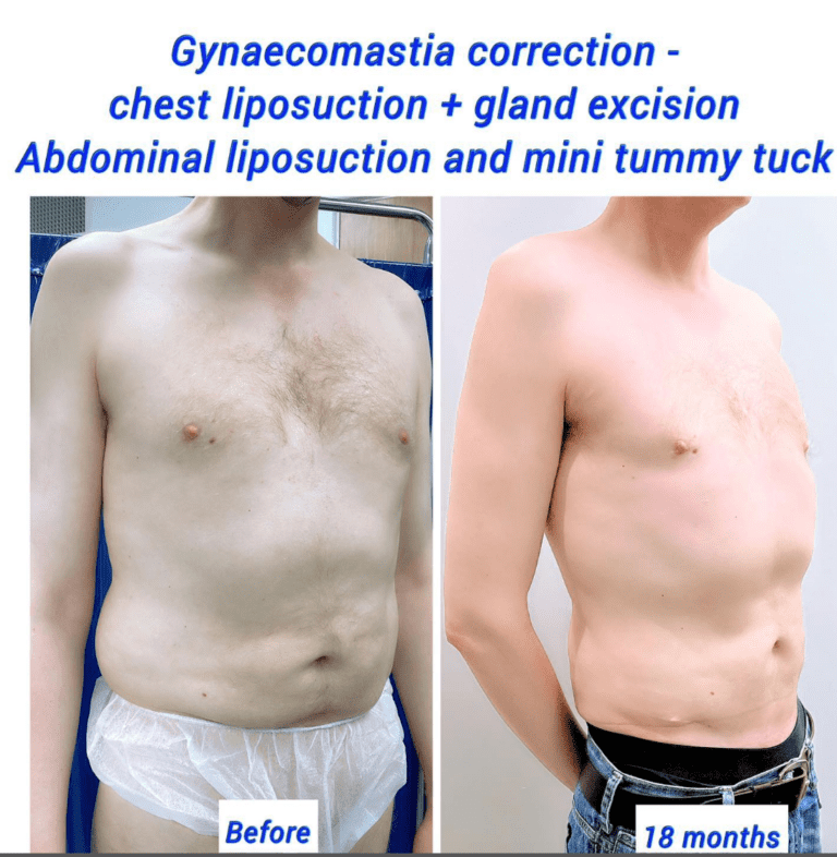 Gynaecomastia correction, chest liposuction, gland excision, abdominal and lower back liposuction, and mini tummy tuck at the Harley Clinic