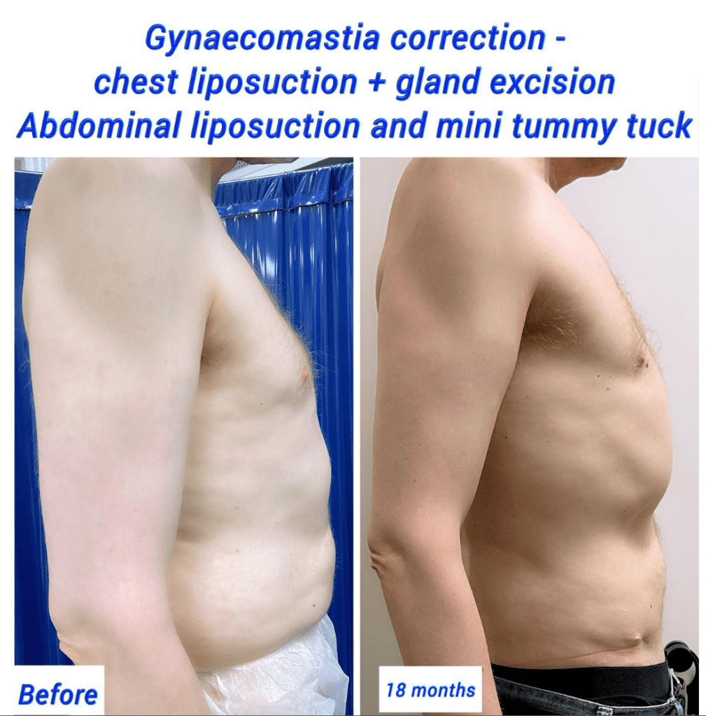 Gynaecomastia correction, chest liposuction, gland excision, abdominal and lower back liposuction, and mini tummy tuck at the Harley Clinic