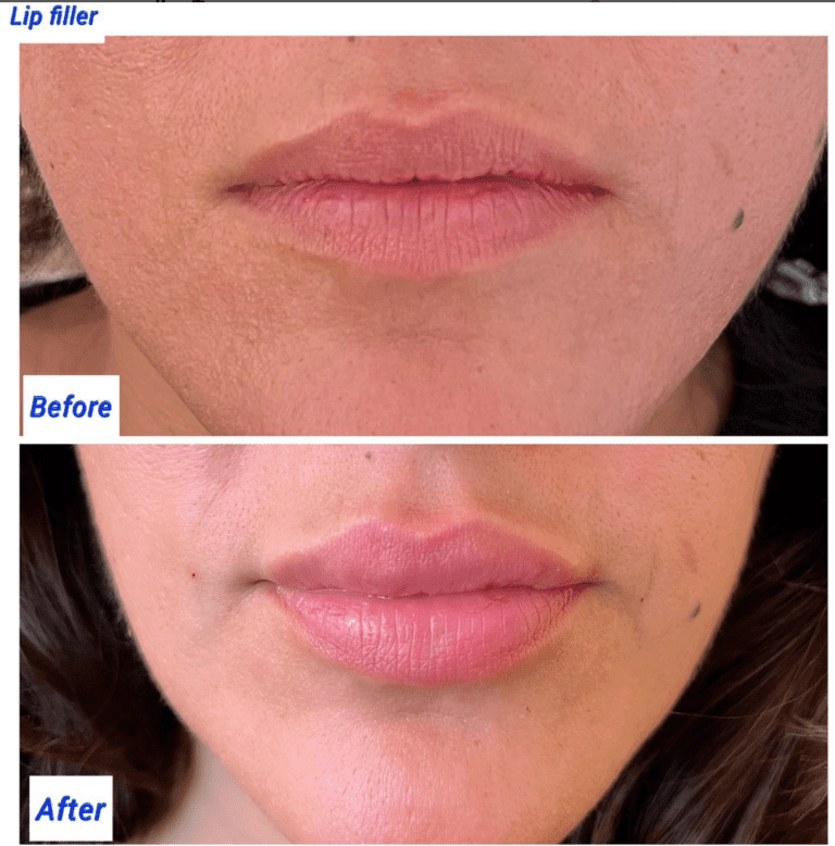 Before and after lip filler at the Harley Clinic