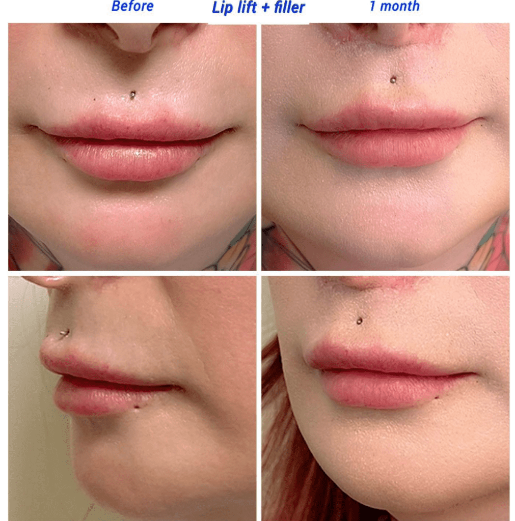 Antes y después de lifting y relleno de labios en Clínica Harley