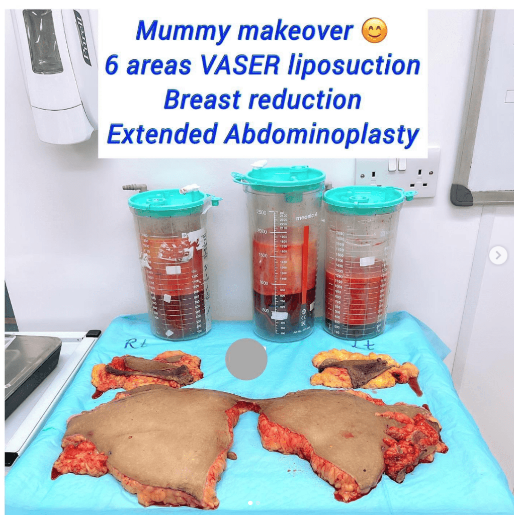 Mummy makeover, vaseer liposuction, breast reduction, and extended abdomnioplasty