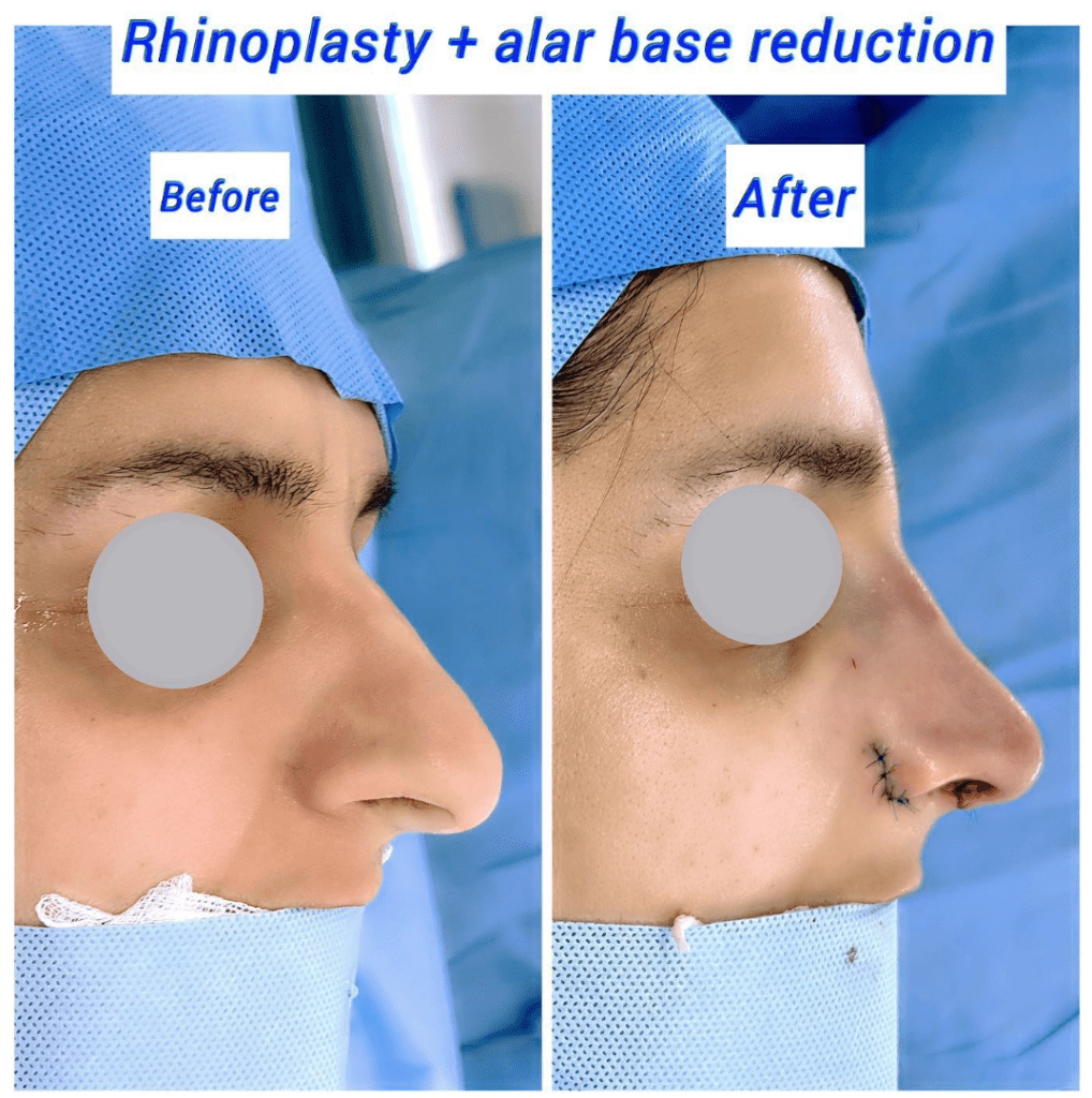 Antes y después de rinoplastia y reducción de base alar en Clínica Harley