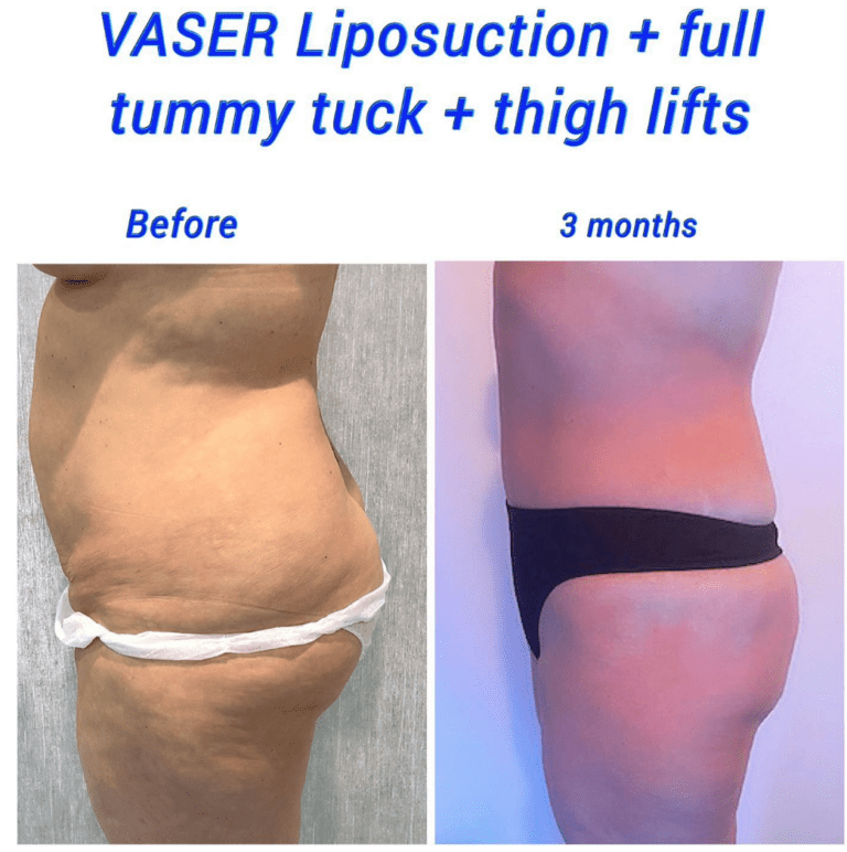 before and after vaser liposuction, fully tummy tuck, and thigh lift
