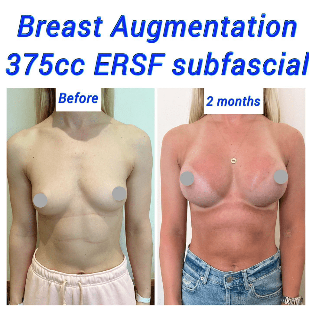 Before and after breast augmentation 375cc ERSF subfascial