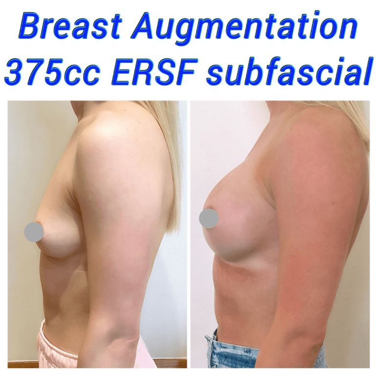 Breast augmentation 375cc ERSF subfascial