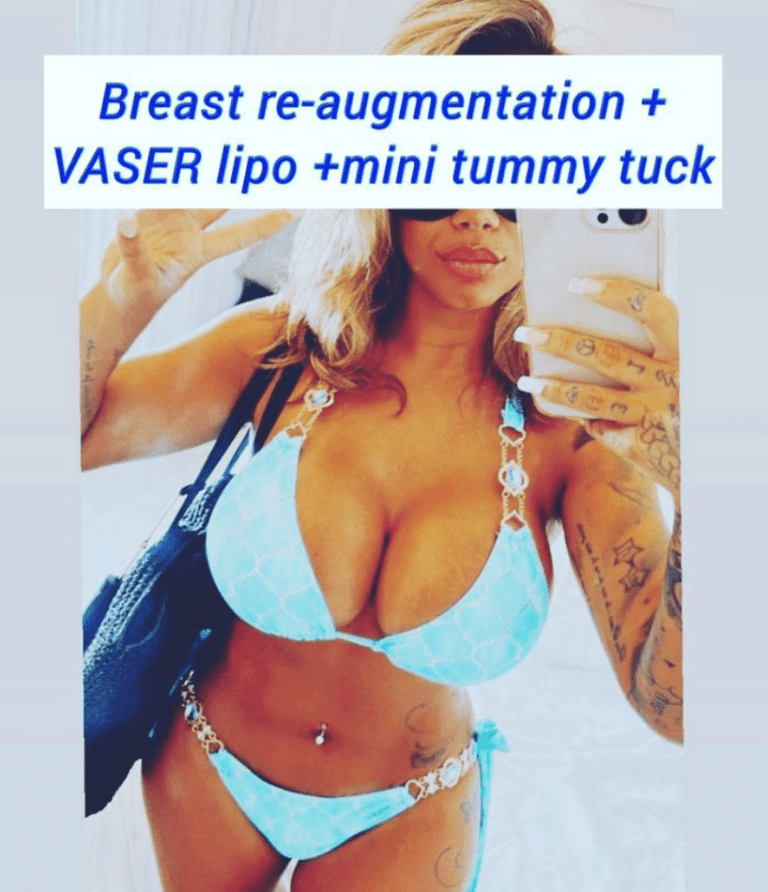 Breast re-augmentation, Vaser lipo, and mini tummy tuck at the Harley Clinic