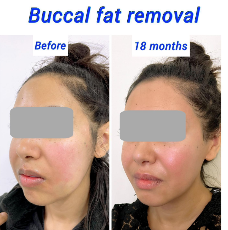 Before and after buccal fat removal (cheek reduction surgery) at the Harley Clinic London