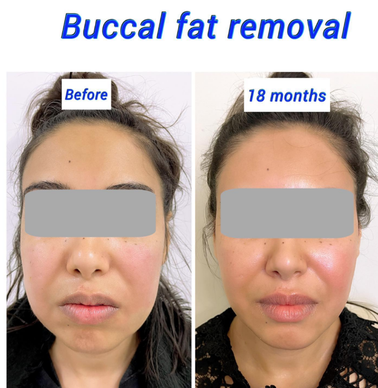 Before and after buccal fat removal (cheek reduction surgery) at the Harley Clinic London