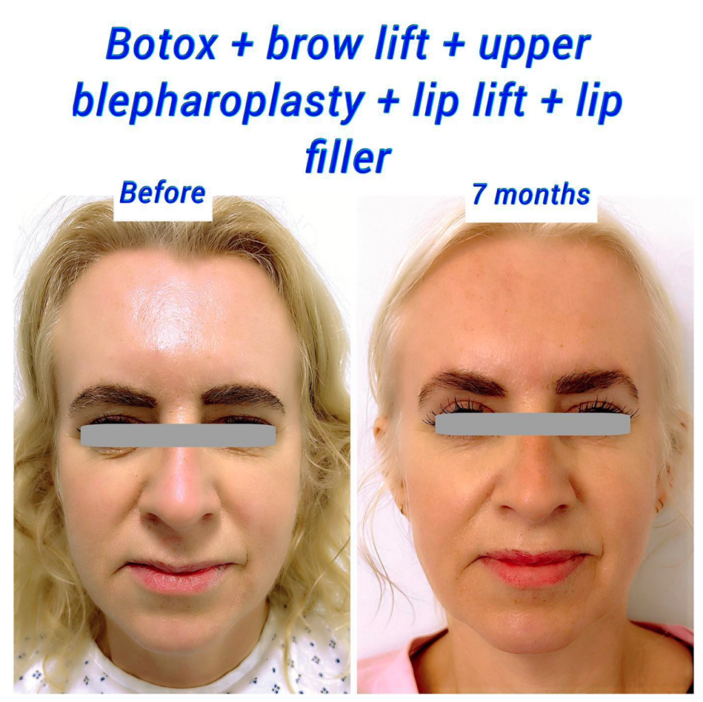 Antes y después de toxina botulínica, lifting de cejas, blefaroplastia superior, lifting de labios y rellenos de labios