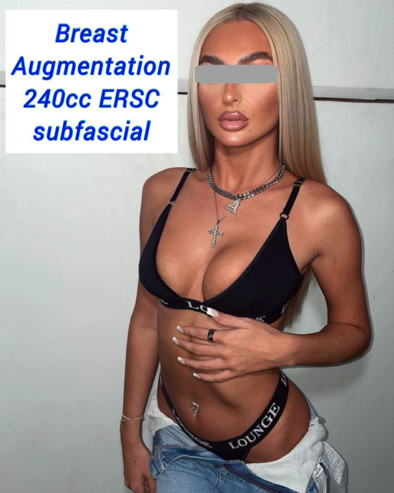 Breast augmentation 240cc ERSC subfascial