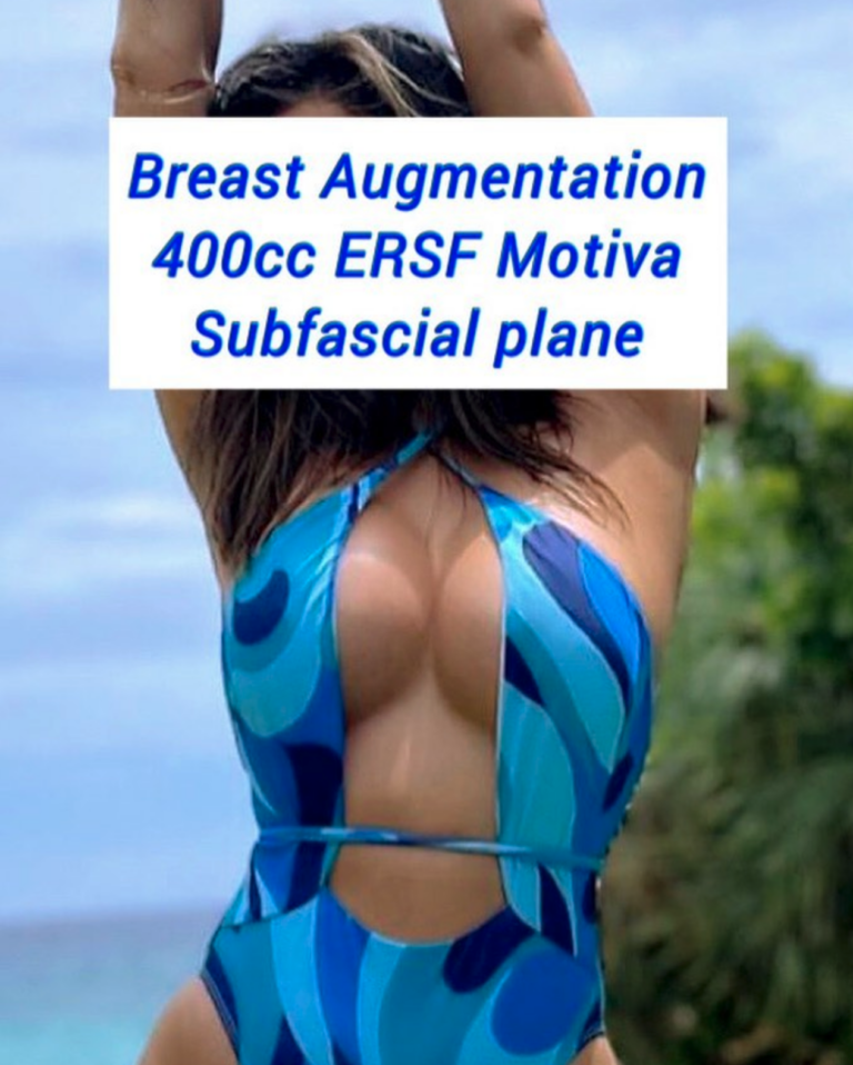 Breast augmentation 400cc ERSF Motiva subfascial, the Harley Clinic London