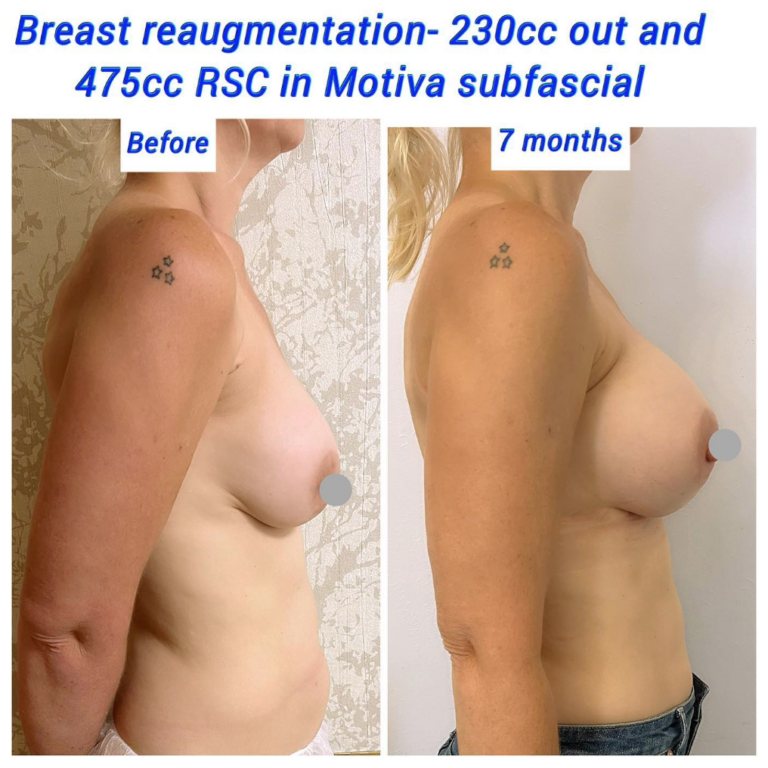 Before and after breast re-augmentation 230cc out and 475cc RSC in Motiva subfascial