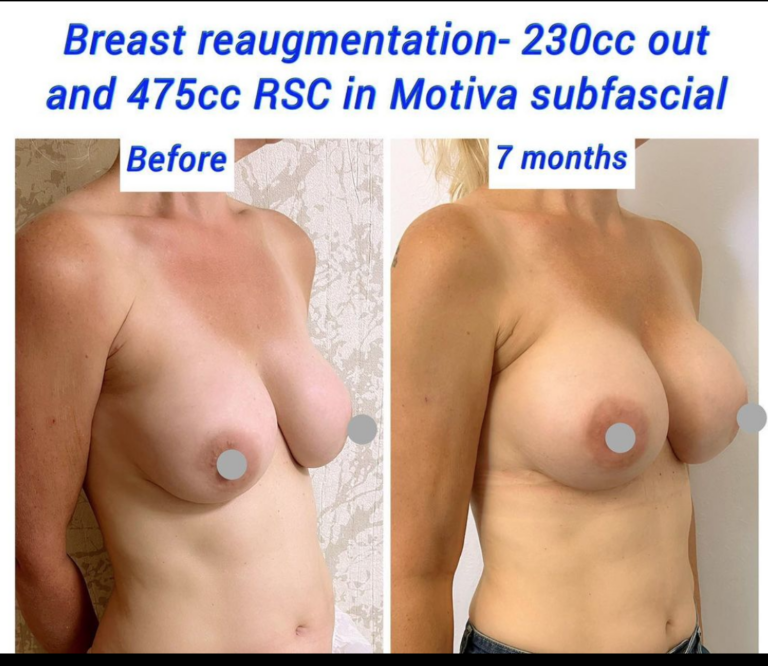 Before and after breast re-augmentation 230cc out and 475cc RSC in Motiva subfascial