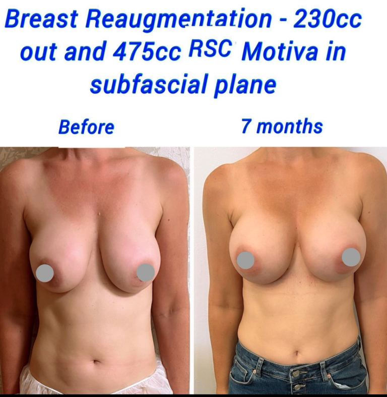 Before and after breast re-augmentation 230cc out and 475cc in RSC Motiva in subfascial plane