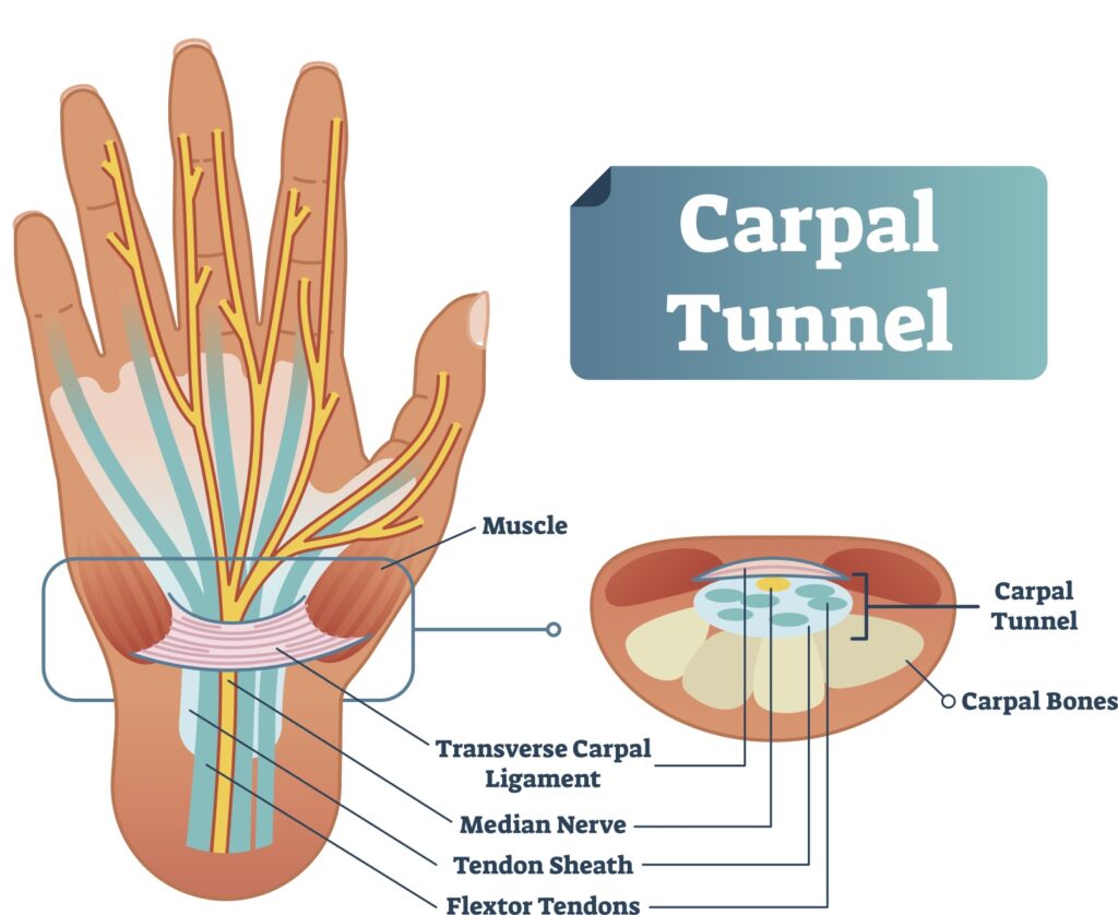 Anatomía del síndrome del túnel carpiano, The Harley Clinic