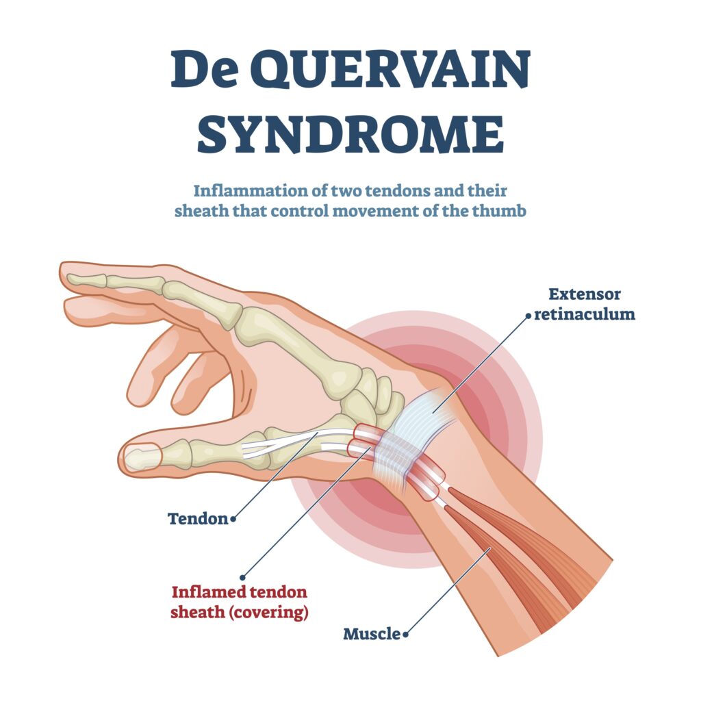 Anatomía del síndrome de De Quervain