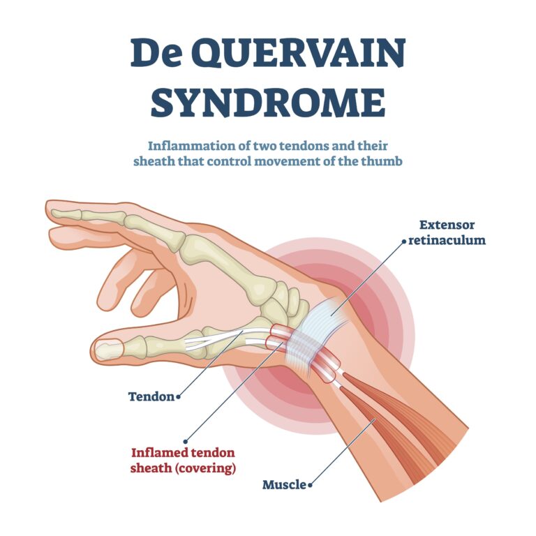 De Quervain Syndrome Anatomy