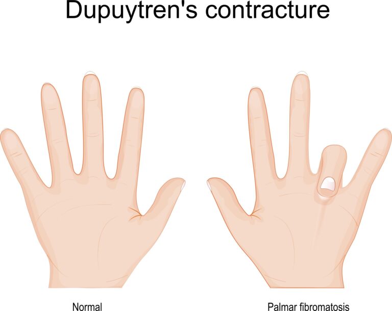 Splints for Dupuytren's Contracture 101 - Harley Clinic