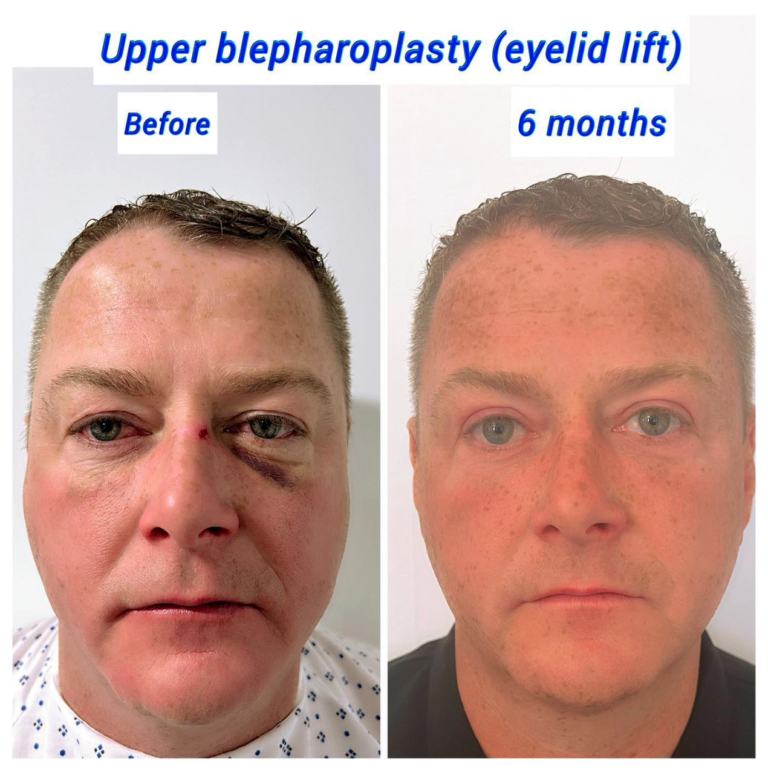Before and after eyelid lift (upper blepharoplasty)