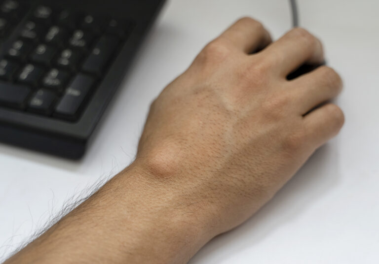 Ganglion cyst on man's hand. Hand holding computer mouse