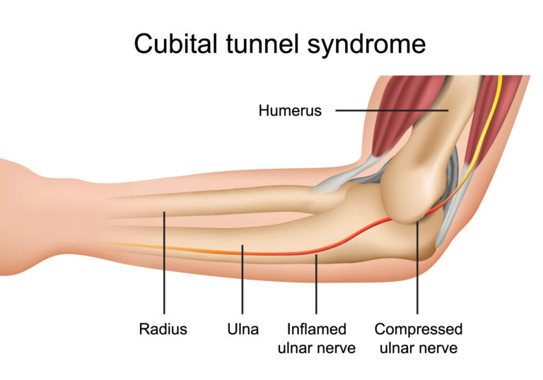 cubital hand syndrome