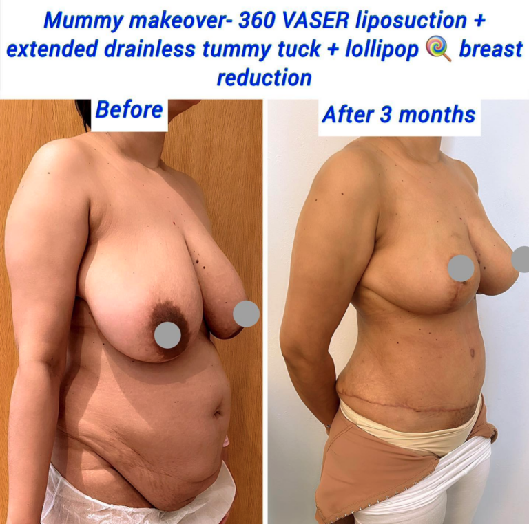 Mummy makeover - VASER liposuction, extended drainless tummy tuck, lollipop lift, breast reduction, The Harley Clinic