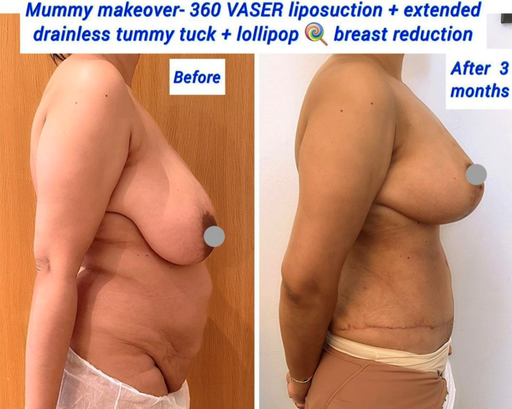 Mummy makeover - VASER liposuction, extended drainless tummy tuck, lollipop lift, breast reduction, The Harley Clinic