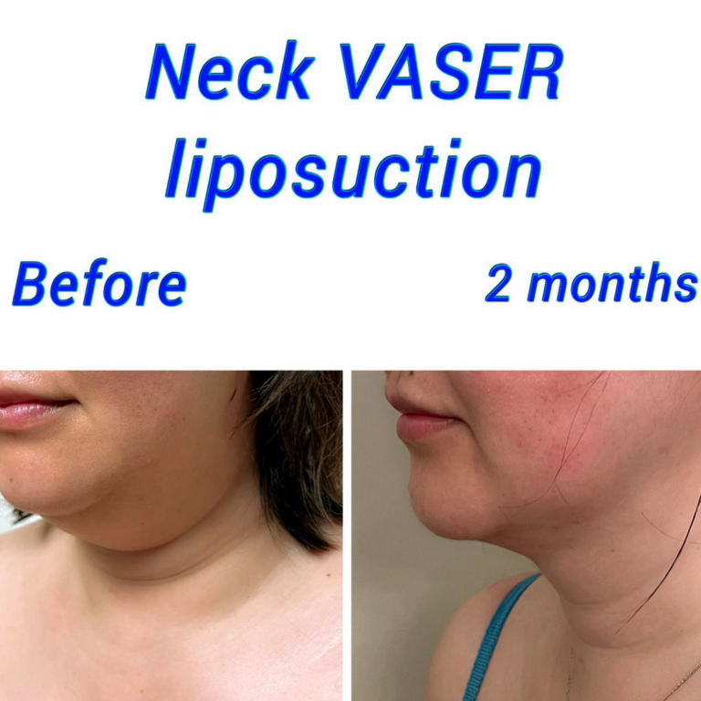 Before and after Neck VASER liposuction at the Harley Clinic London