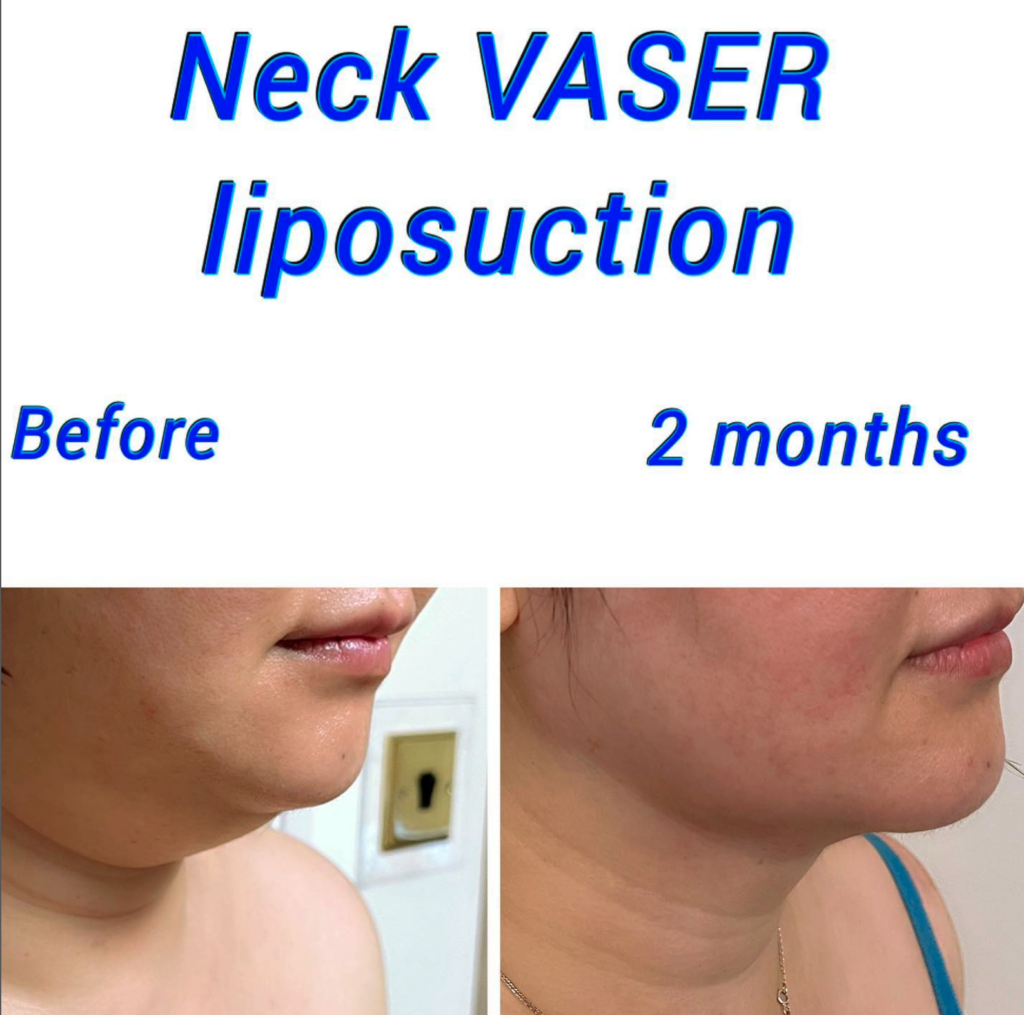 Antes y después de la liposucción de cuello VASER en Harley Clinic London