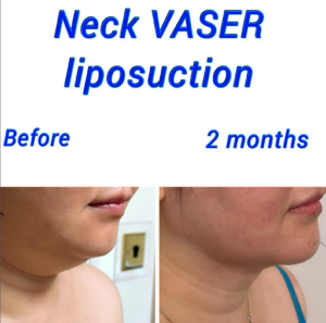 Before and after Neck VASER liposuction at the Harley Clinic London