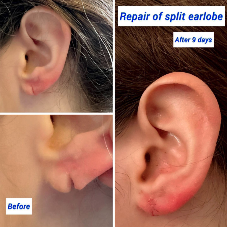 Before and after split earlobe repair at The Harley Clinic London