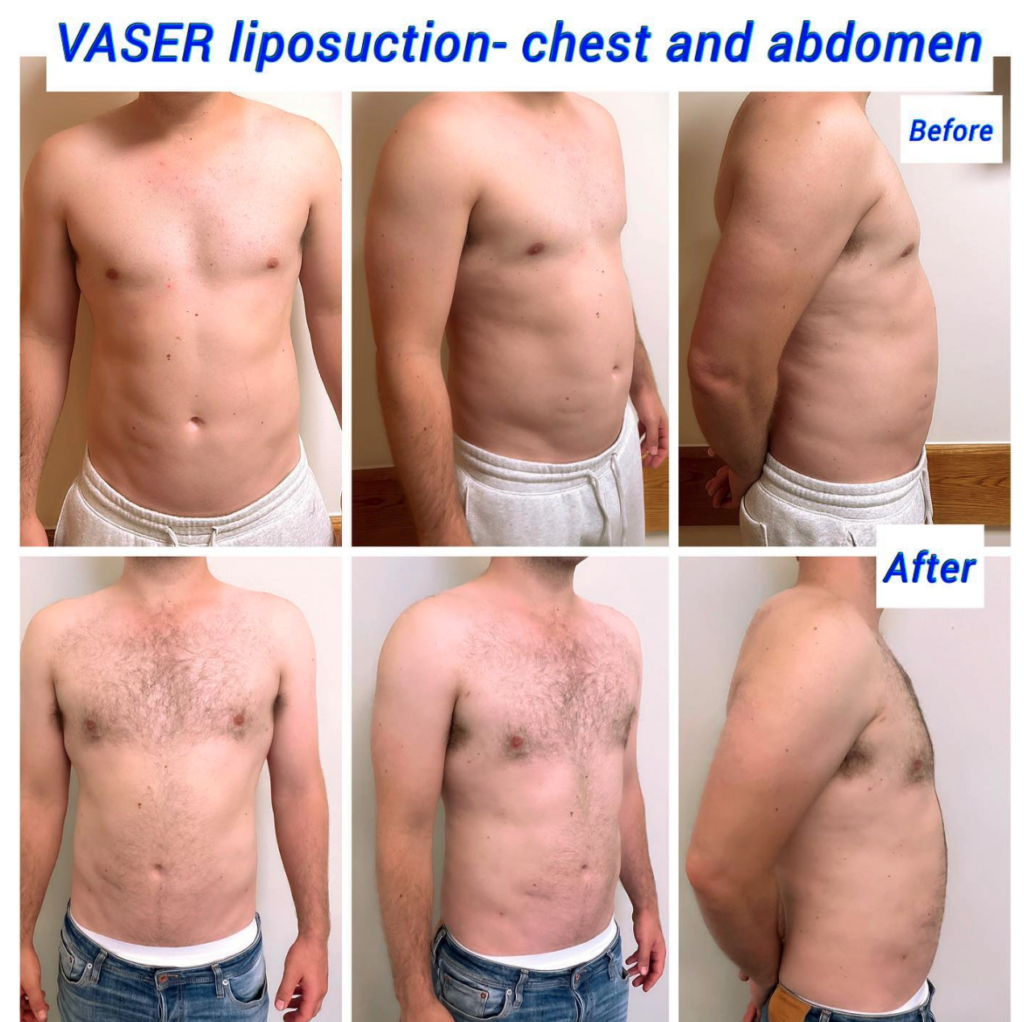Before and after Vaser liposuction chest and abdomen