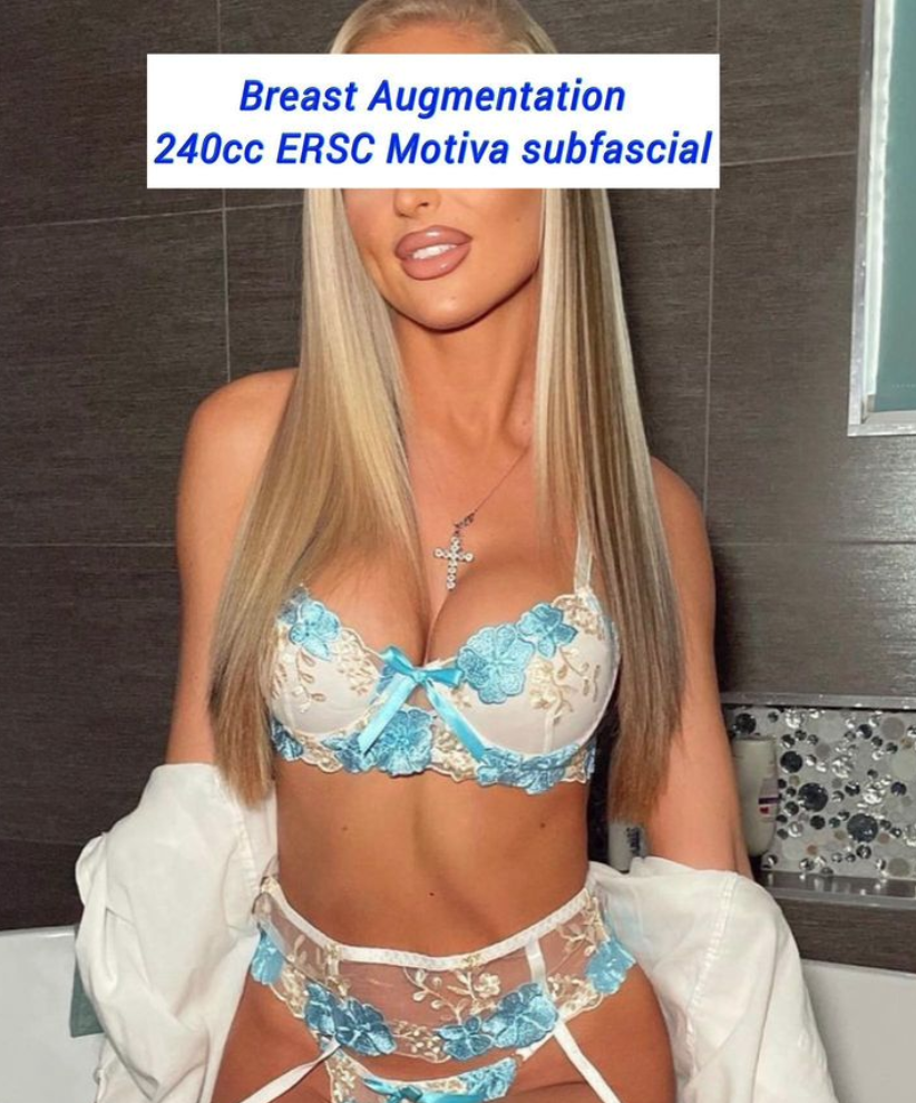 Breast augmentation 240cc ERSC Motiva subfascial