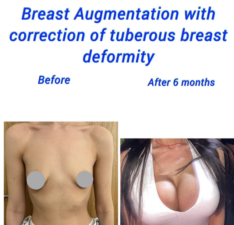 Before and after breast augmentation with correction of tuberous breast deformity