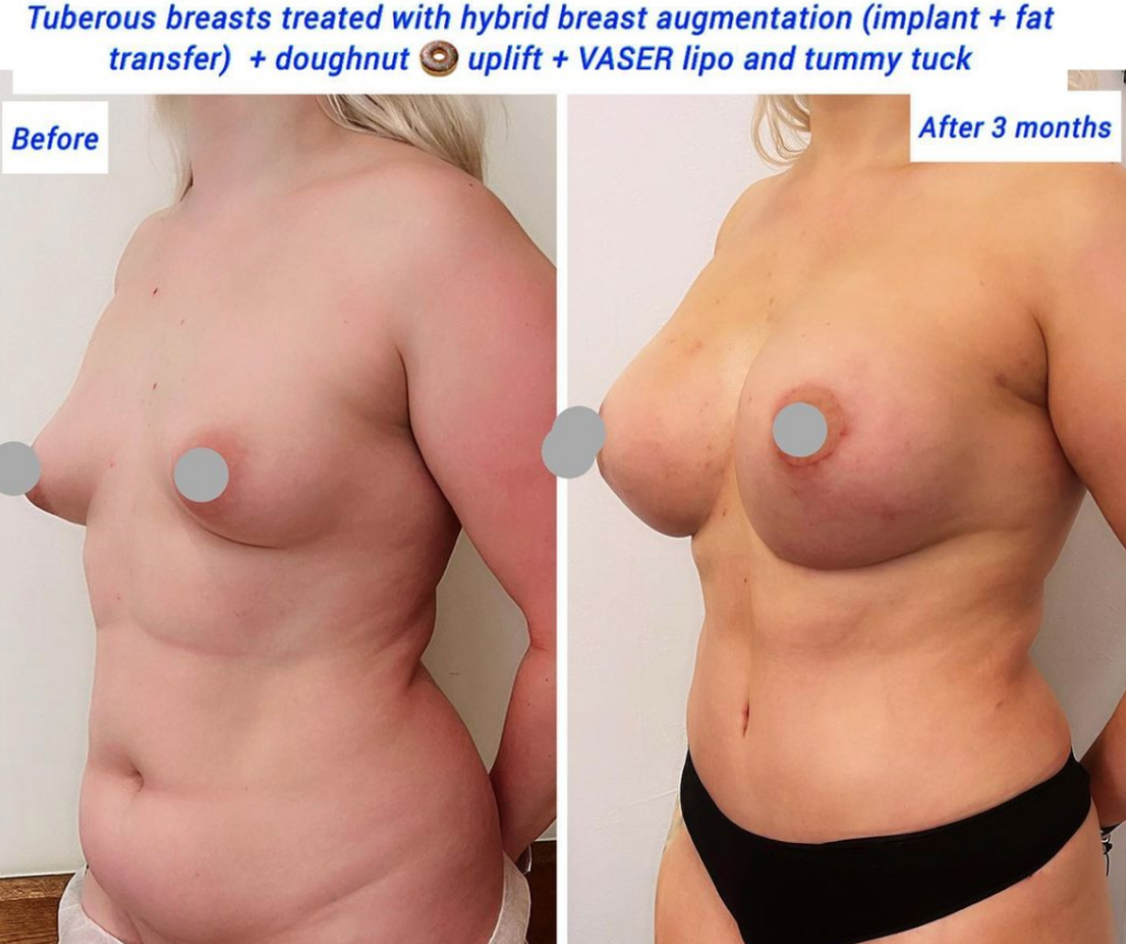 Tuberous breasts treated with hybrid breast augmentation, doughnut uplift, VASER lipo, tummy tuck